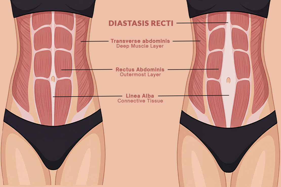 Understanding Diastasis Recti & How Yoga Can Help Recovery